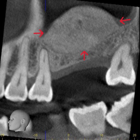 Sinus Lift