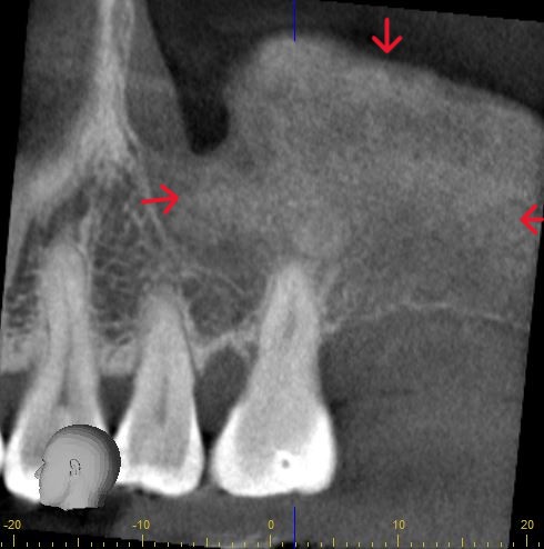 Sinus Lift